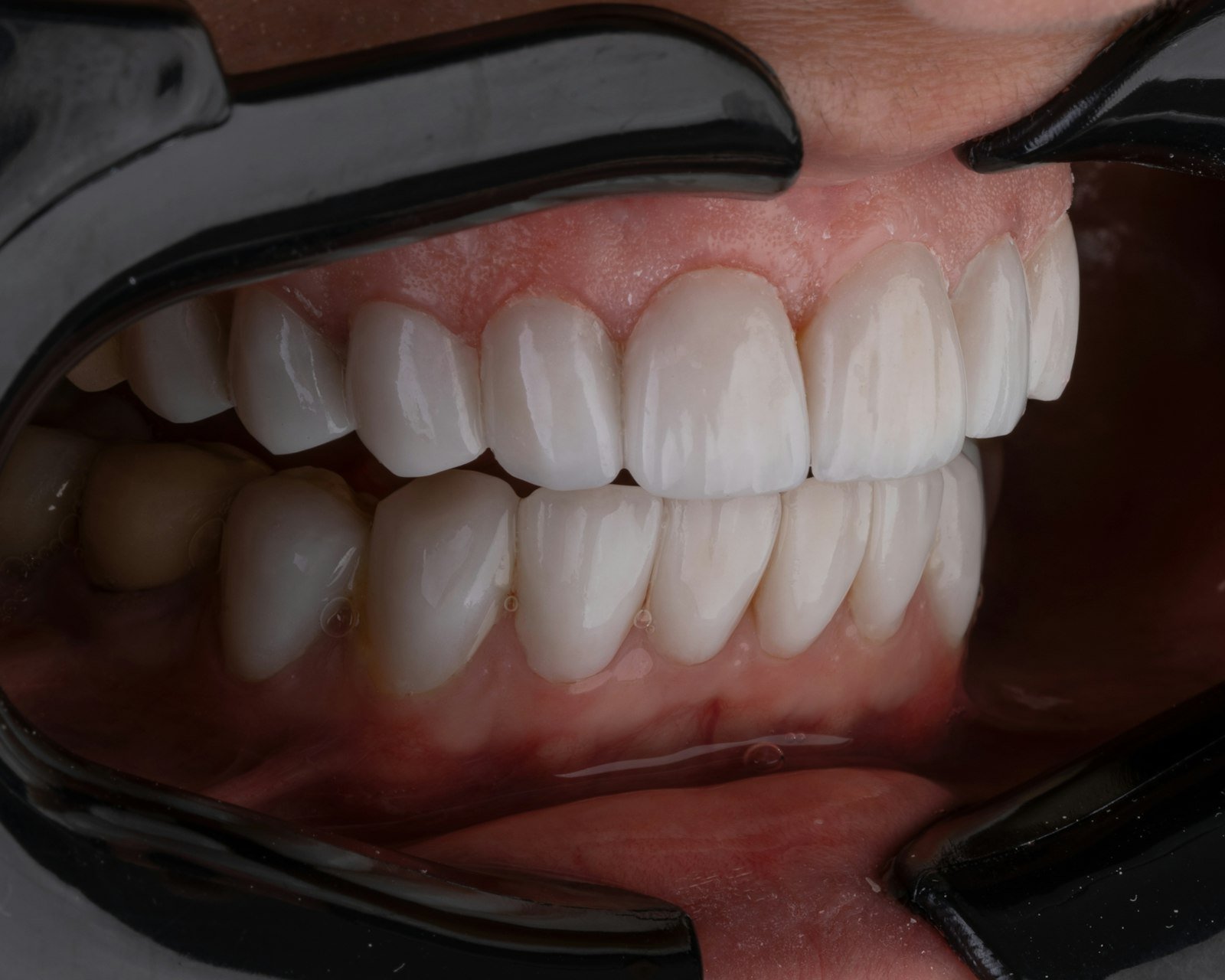 A bright, natural smile following cosmetic treatment